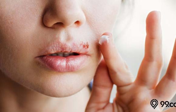 cara mengobati herpes