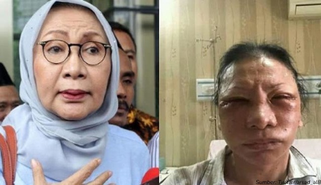 Bukan hanya Ratna Sarumpaet, Inilah 7 Artis Indonesia yang Gagal Operasi Plastik. Wajahnya Membengkak jadi Aneh?