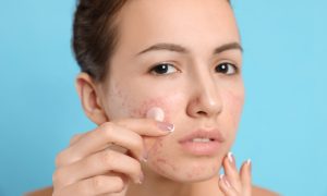 6 Rekomendasi Acne Patch Terbaik untuk Kulit Berjerawat. Cobain, yuk!